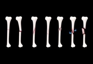 عظام وروماتيزم